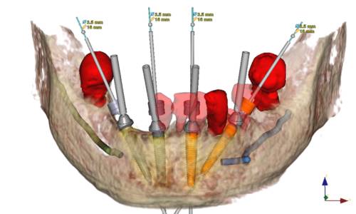 Implantologie – Planung