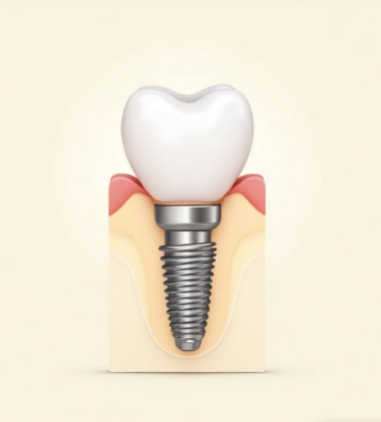 Illustration: Implantat mit Krone