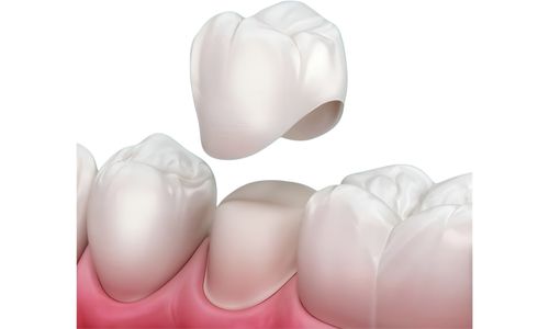 Beispiel: Krone / Stabilisierung eines Zahnes