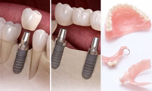 Vergleich: Implantat, Brücke und herausnehmbarer Zahnersatz