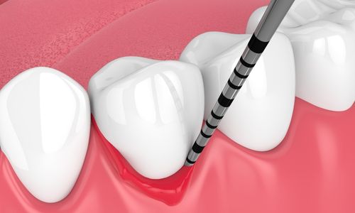 Schematische Darstellung der Untersuchung am Zahnfleischrand