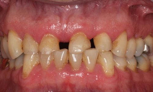 Analyse der Bisslage bei funktioneller Rekonstruktion