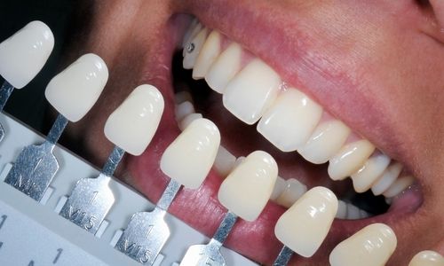 Bestimmung der Zahnfarbe vor und nach Bleaching