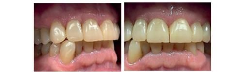 Flowable Injection Technique – Schablonentechnik für präzise additive Formkorrektur