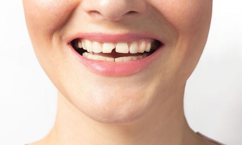 Zahnarztpraxis Dres. Braunschweiger & Gebauer - Flowable Injection Technique | Substanzschonende Frontzahnkorrektur 1