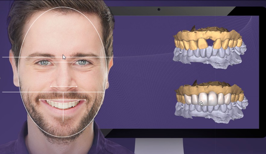 Digitale Smile-Design-Planung vor Veneer-Behandlung