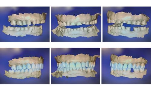 Digitale Planung vor Injection Technique – Form und Funktion